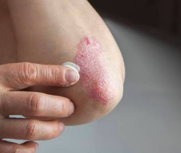 A exclusão social de indivíduos com doenças dermatológicas visíveis
